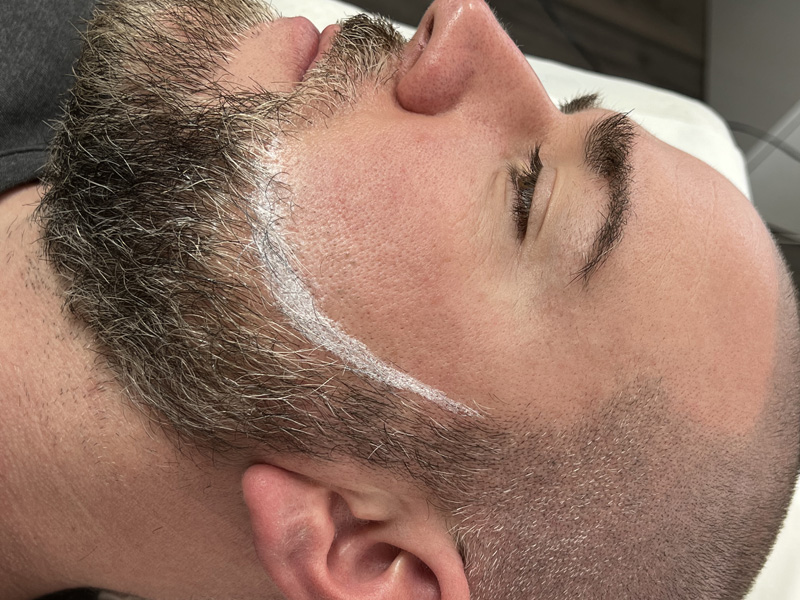 Beard Micropigmentation