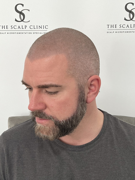 Beard Micropigmentation