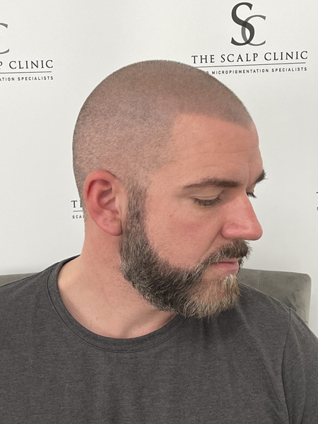 Beard Micropigmentation