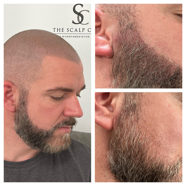 Beard Micropigmentation