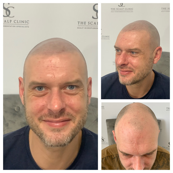 Male Pattern Baldness (10)