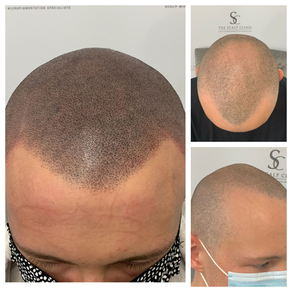 Male Pattern Baldness (11)