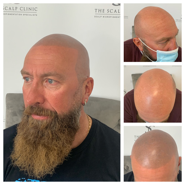 Male Pattern Baldness (15)