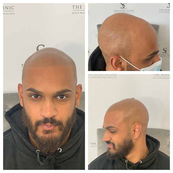 Male Pattern Baldness (19)