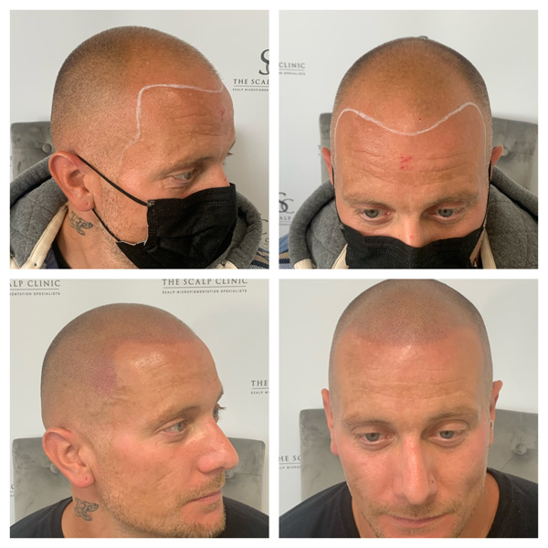 Male Pattern Baldness (5)
