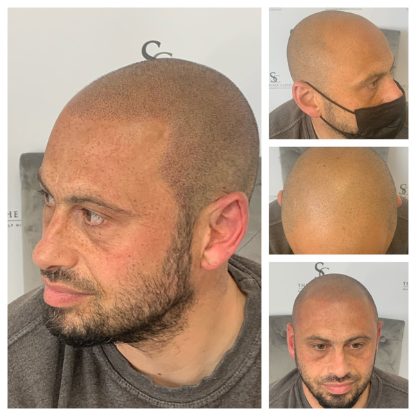 Male Pattern Baldness (8)
