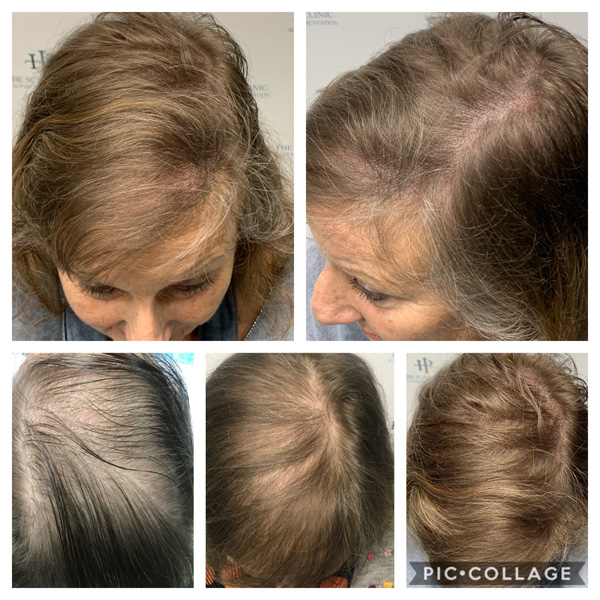 Scalp Mcropigmentation Women (1)