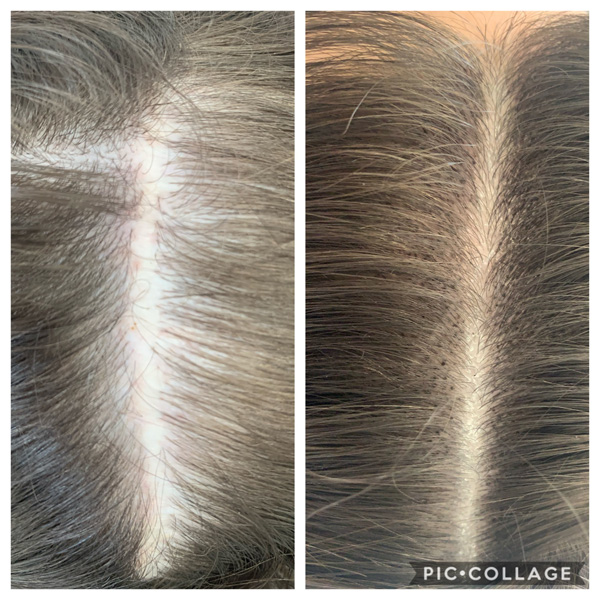 Scalp Mcropigmentation Women (10)