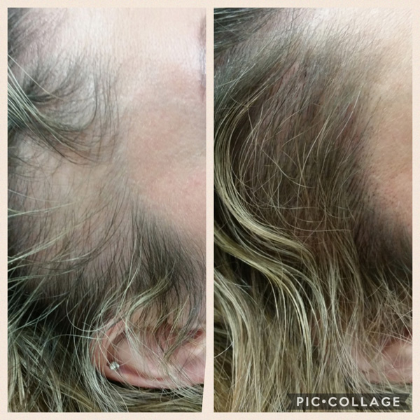 Scalp Mcropigmentation Women (11)