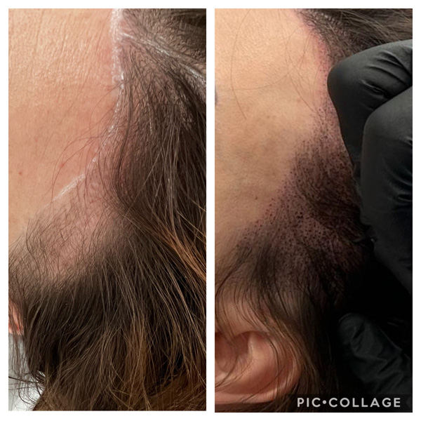 Scalp Mcropigmentation Women (2)