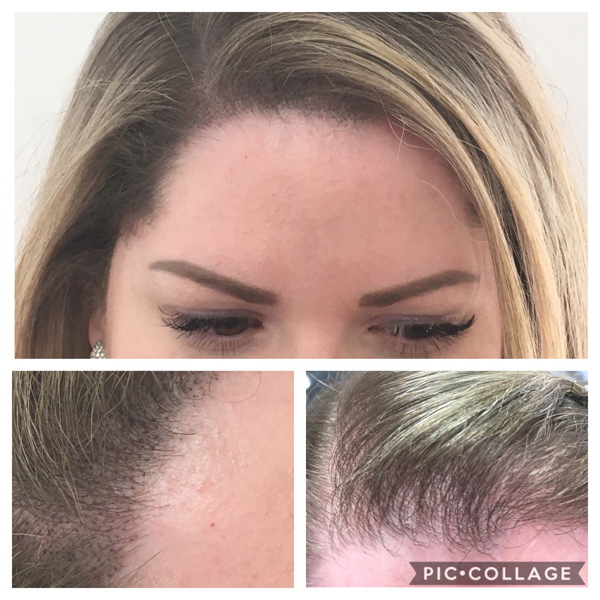 Scalp Mcropigmentation Women (4)