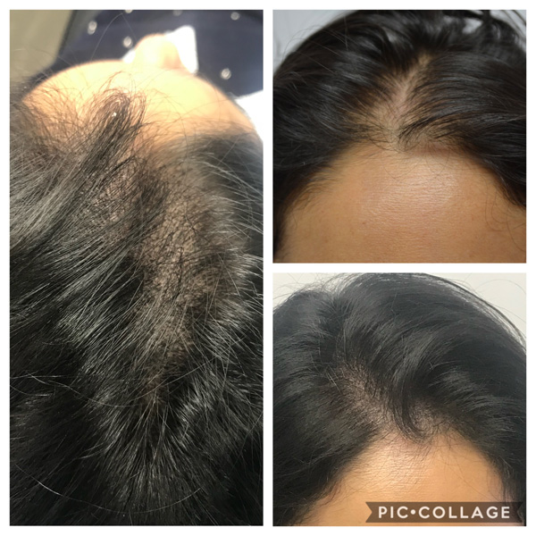 Scalp Mcropigmentation Women (5)