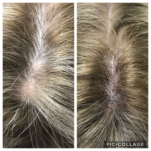 Scalp Mcropigmentation Women (7)