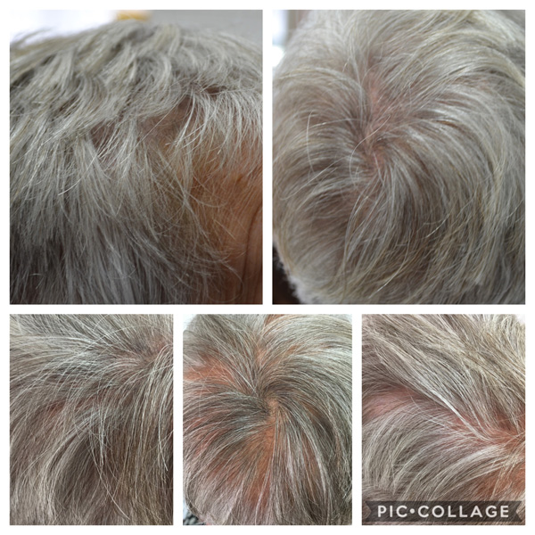 Scalp Mcropigmentation Women (8)