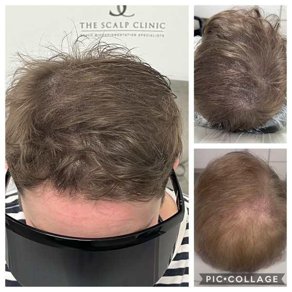 Scalp Mcropigmentation Women (9)