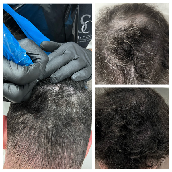 Thinning Hair Examples