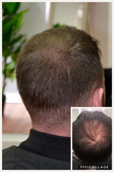 Thinning Hair Examples