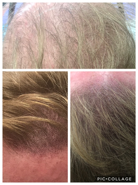 Thinning Hair Examples