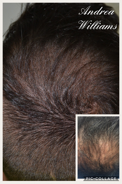 Thinning Hair Examples