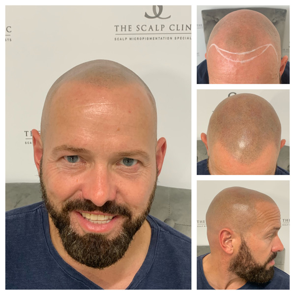 scalp micropigmentation examples