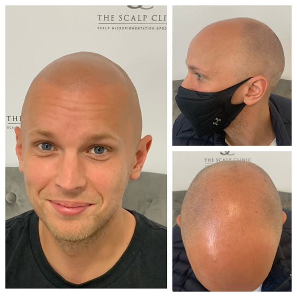 scalp micropigmentation examples