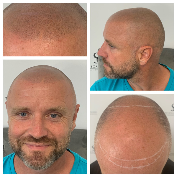 scalp micropigmentation examples