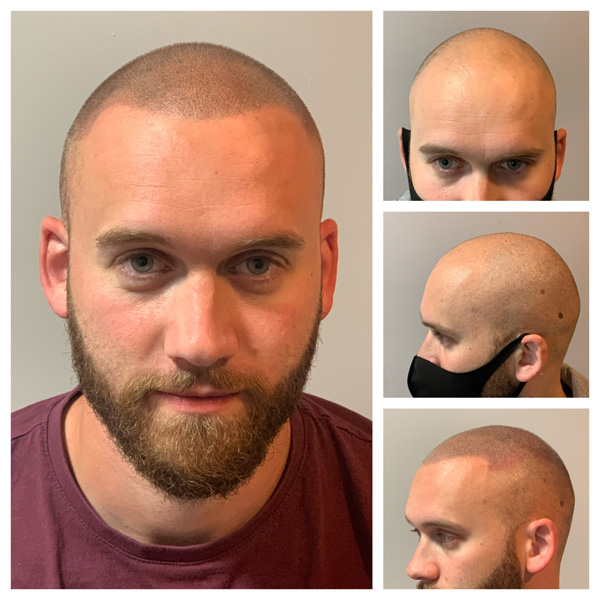 scalp micropigmentation examples